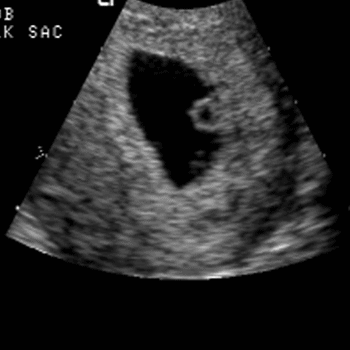Yolk Sac with Gestational Sac OB Obstetric Obstetrical Ultrasound