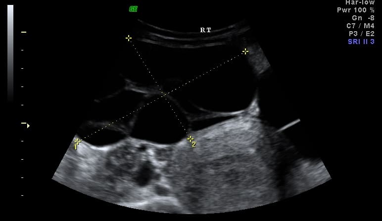 bilateral-ovarian-serous-cystadenoma pelvic ultrasound