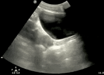 tilting-longitudinally-bladder ultrasound
