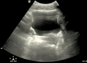 tilting-transverse-bladder ultrasound