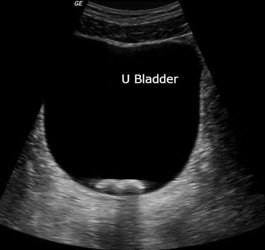 urinary bladder stone calculus ultrasound