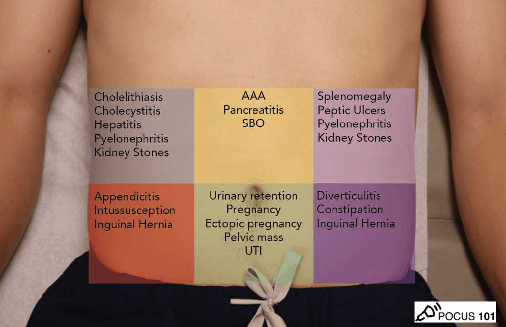 Abdominal Pain Quadrants by Diagnosis - Ultrasound - POCUS 101