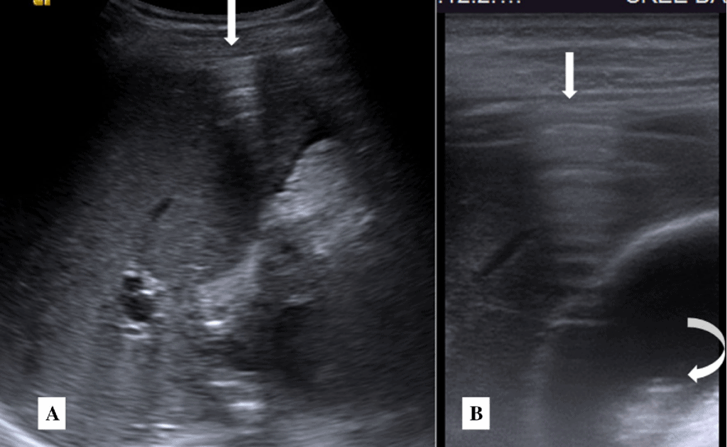 Abdominal Ultrasound Pneumoperitoneum Enhanced Peritoneal Stripe Sign