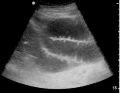 Abdominal Ultrasound Small Bowel Obstruction Dilated Loops Haustra