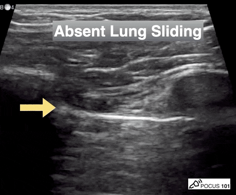 Absent Lung Sliding Ultrasound