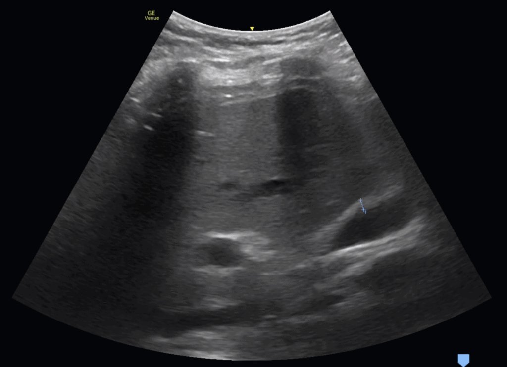 Anterior Gallbladder Wall thickness Measurement