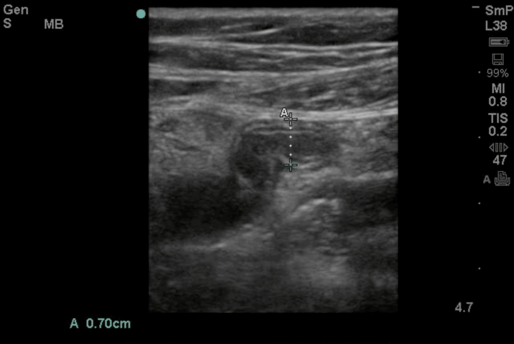 Appendicitis Ultrasound Long Axis Blind Ended Pouch