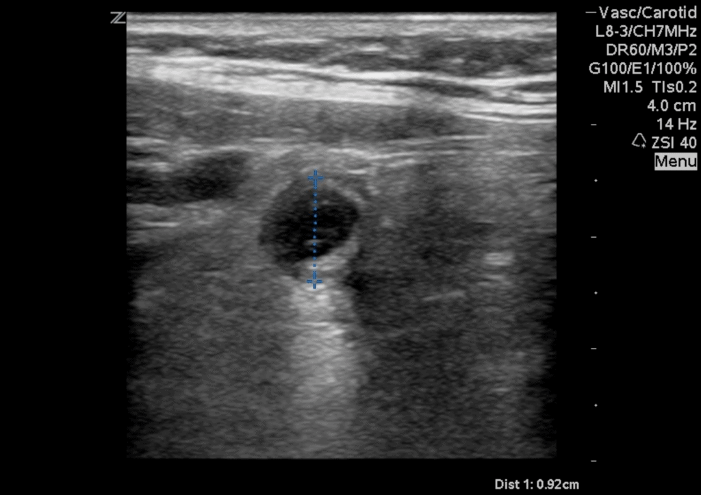 Appendicitis Ultrasound with Target Sign and Dilated