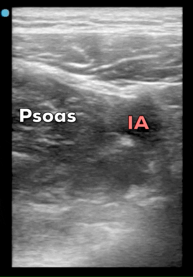 Appendix Appendicitis Landmark Psoas Muscle and Iliac Artery Ultrasound