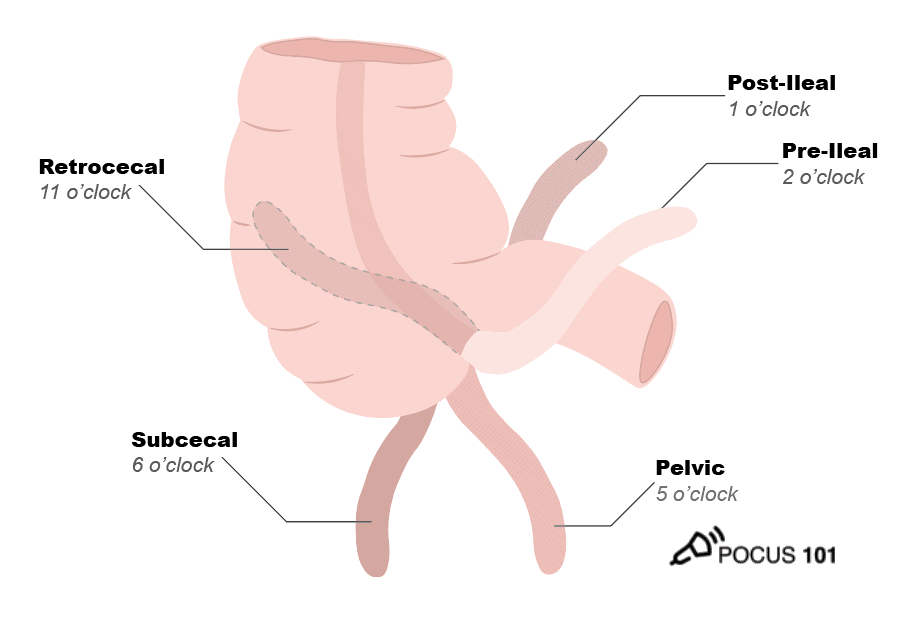 Appendix Appendicitis Ultrasound Locations