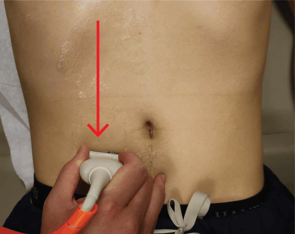 Appendix Appendicitis Ultrasound Sliding Ascending Colon