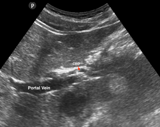 CBD Common Bile Duct Long Axis Ultrasound