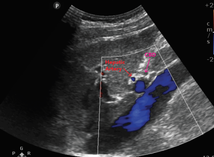 CBD, hepatic artery, and portal vein, Color Flow Doppler Ultrasound