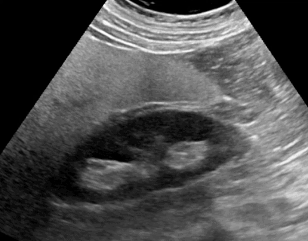 Cirrhotic Liver Ultrasound Hyperechoic