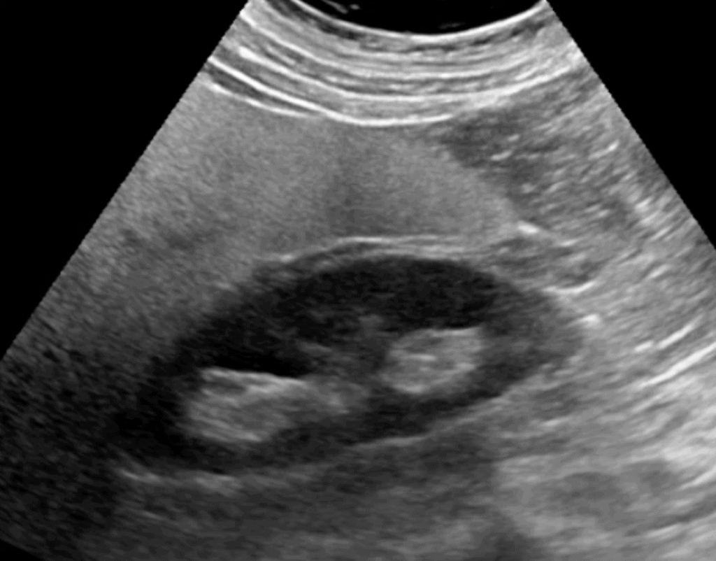 Abdominal Ultrasound Made Easy: Step-By-Step Guide - POCUS 101