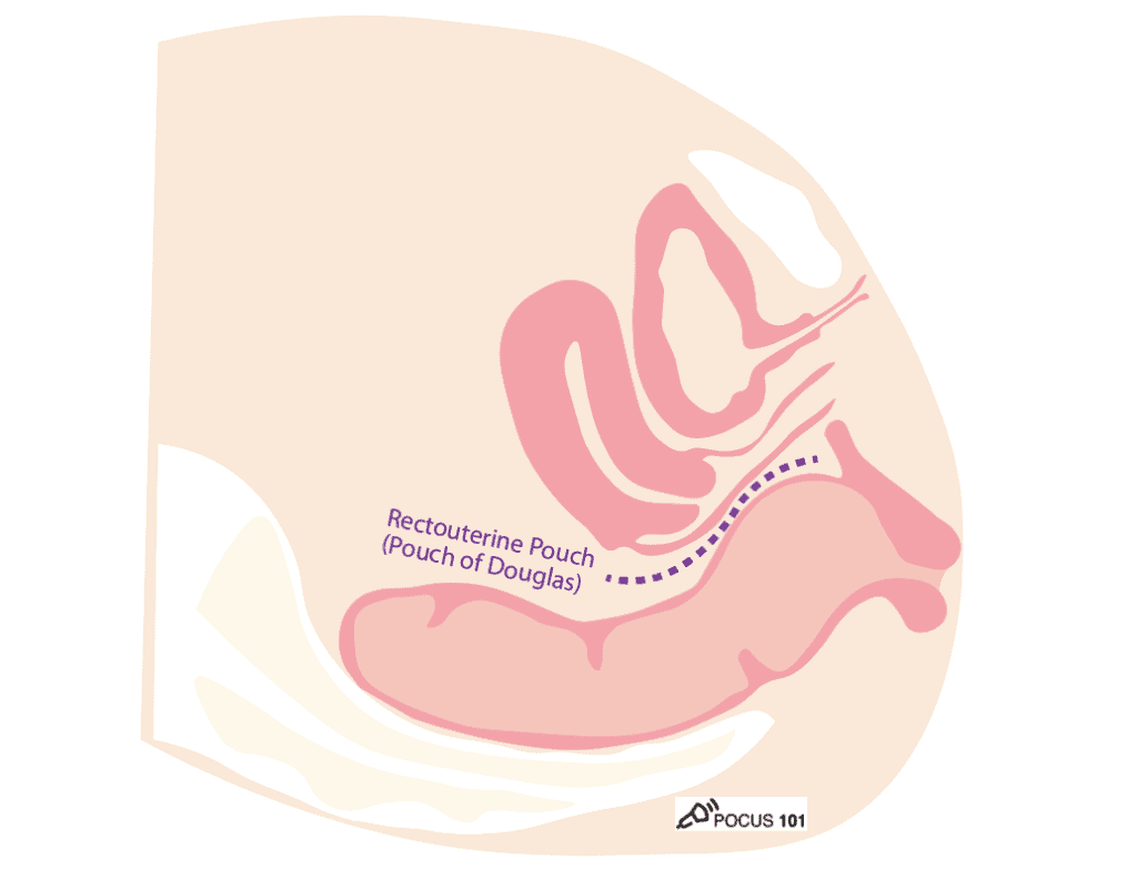 Female Pelvis Rectouterine Pouch of Douglas eFAST ultrasound Potential Space