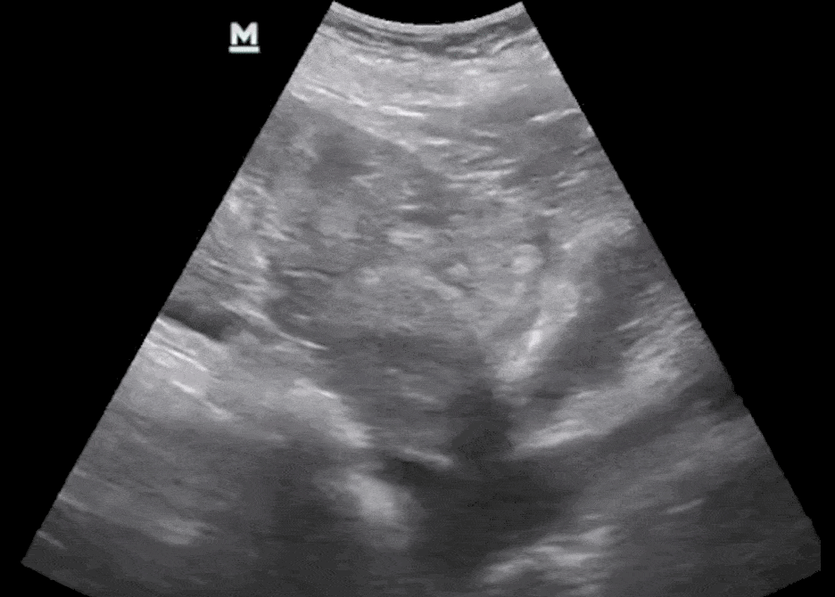Free Fluid Female Pelvis Abdominal eFAST Ultrasound
