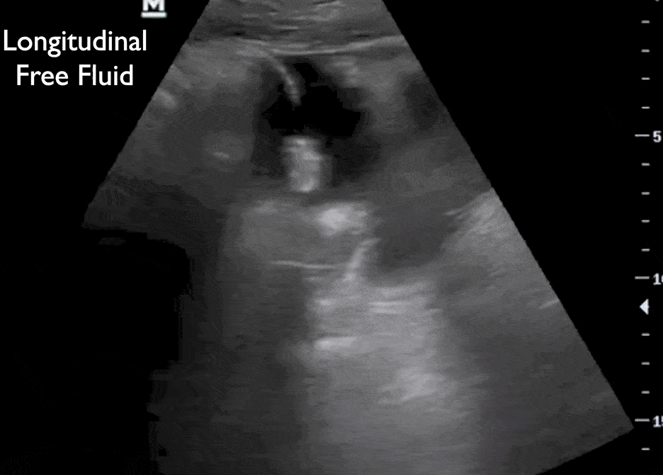 Free Fluid Male Pelvis Abdominal eFAST Ultrasound