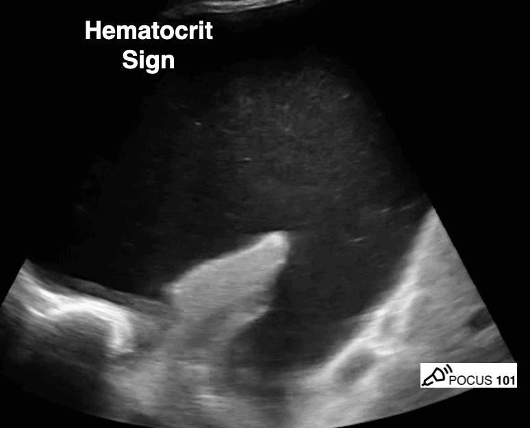 Hematocrit Sign Pleural Effusion Lung Ultrasound