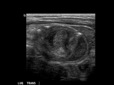 Intussusception abdominal ultrasound pseudokidney sign