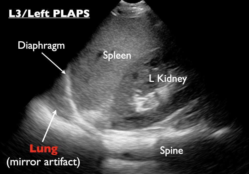 L3 Left PLAPS labeled - Spleen diaphragm lung, spine