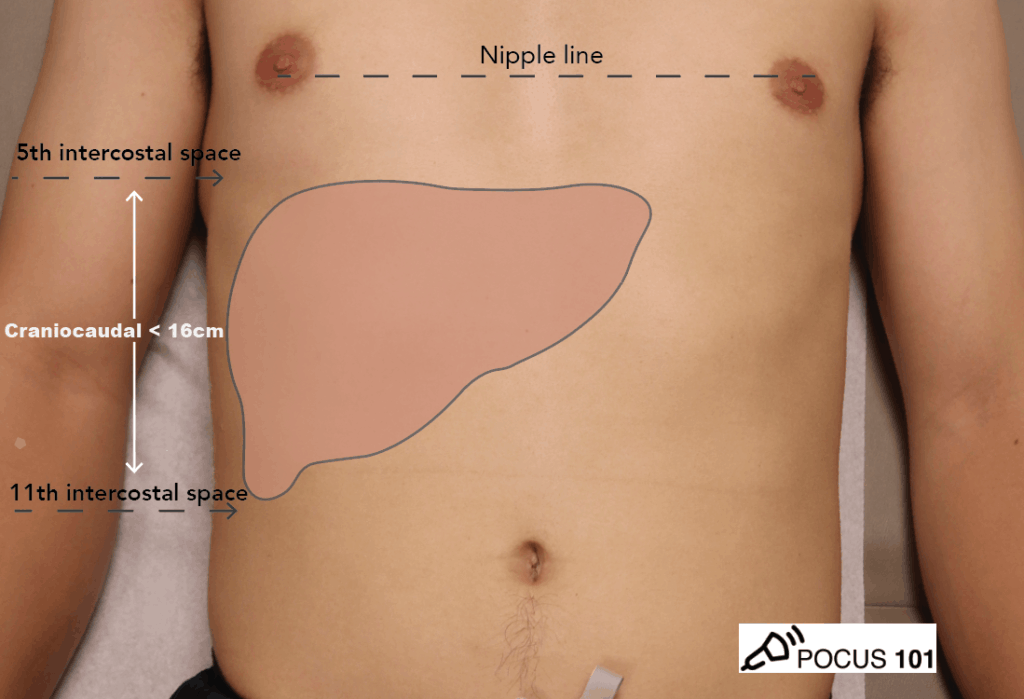 Liver Ultrasound Anatomy Labeled - POCUS 101