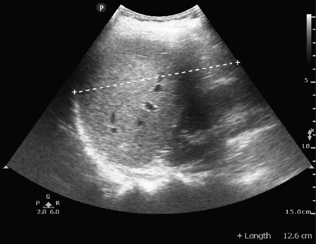 Liver Ultrasound Measurement Normal
