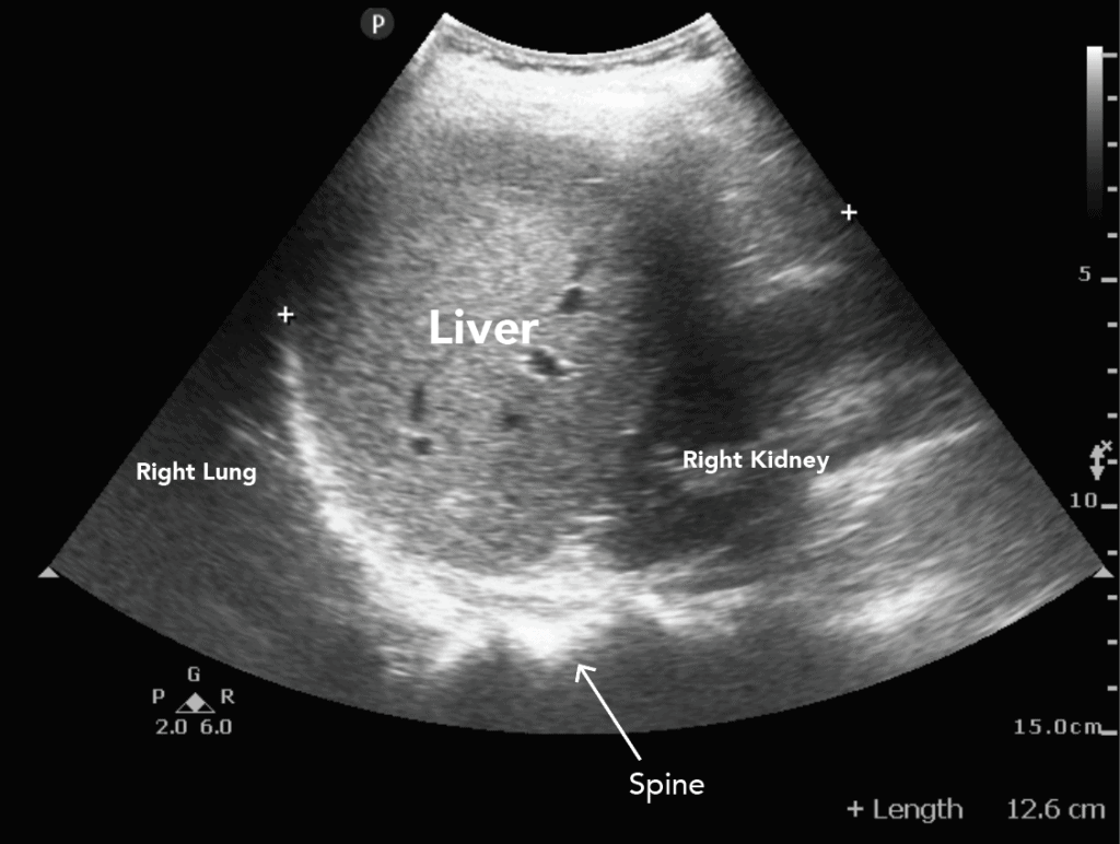 Liver Ultrasound Normal Labeled