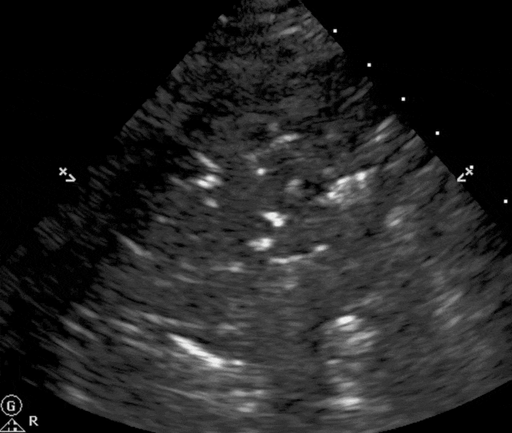 Lung Consolidation Ultrasound