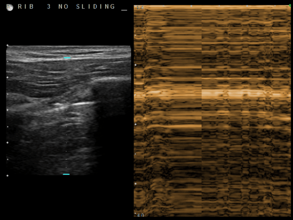 picture of pneumothorax m mode ultrasound