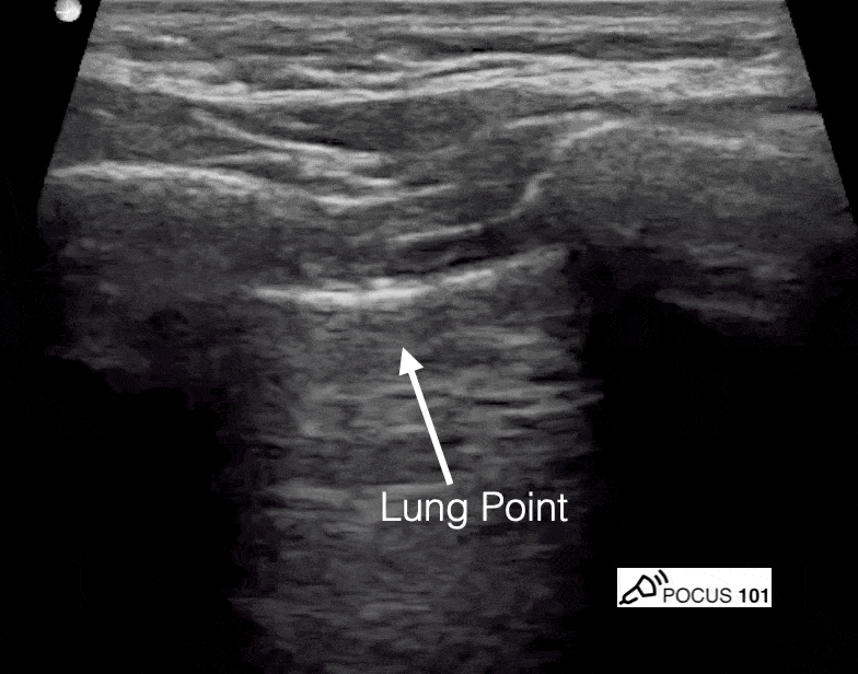 Lung Point - Ultrasound Pneumothorax