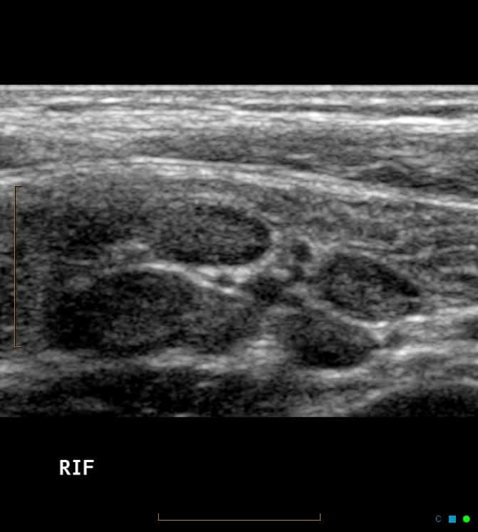 Mesenteric Adenitis Abdominal Ultrasound Appendicitis Mimics Appendix