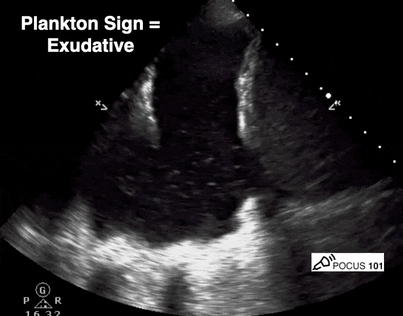 Plankton Sign Pleural Effusion Lung Ultrasound