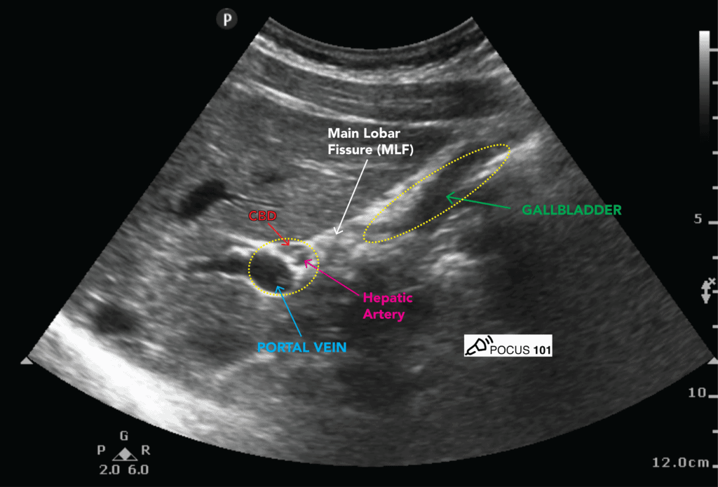 Portal Triad - Exclamation Point Sign, Portal Vein, CBD, Right Hepatic Artery - Hepatobiliary Ultrasound