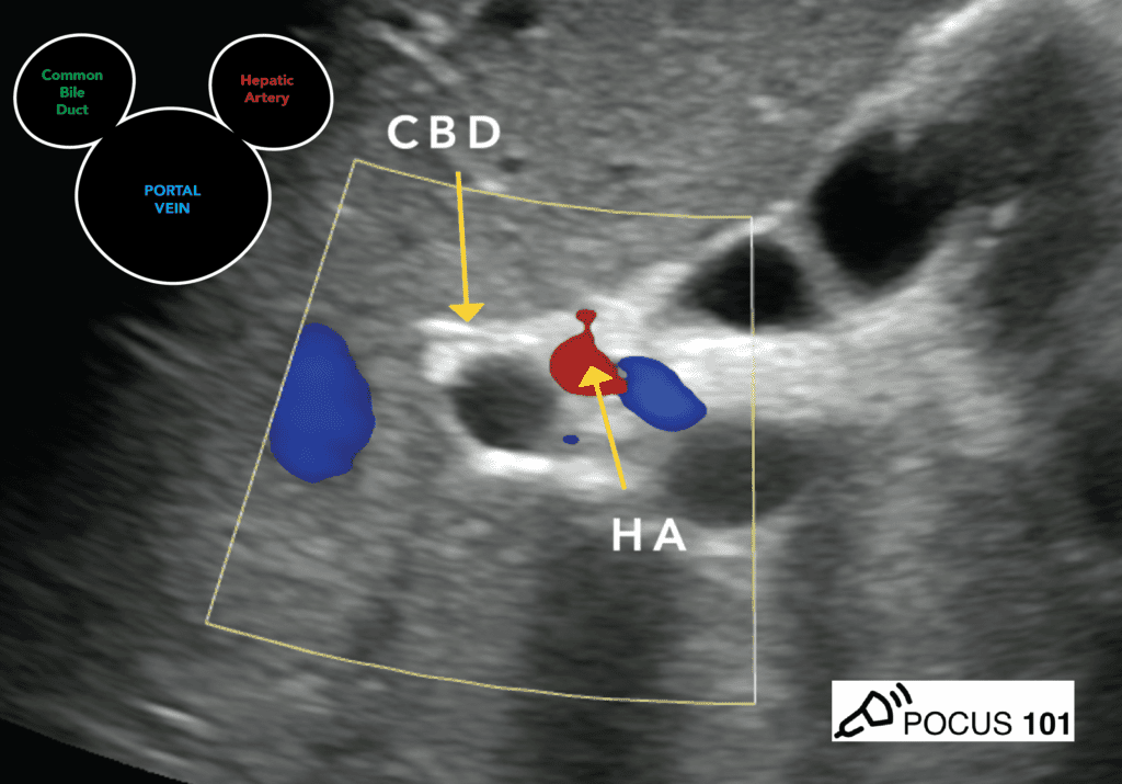 Portal Triad - Mickey Mouse Sign, Portal Vein, CBD, Right Hepatic Artery - Hepatobiliary Ultrasound 2