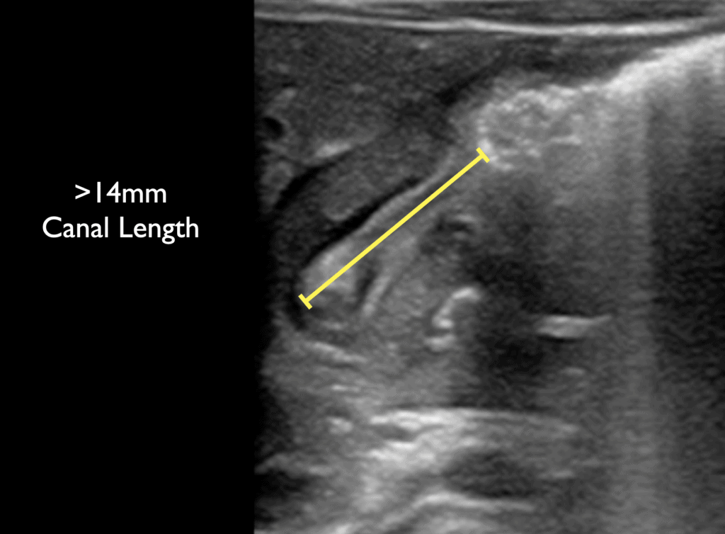 Pyloric Stenosis Abdominal Ultrasound Increased Muscle Thickness