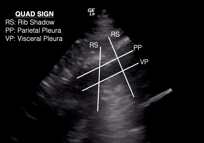 Quad Sign Lung Ultrasound Labeled