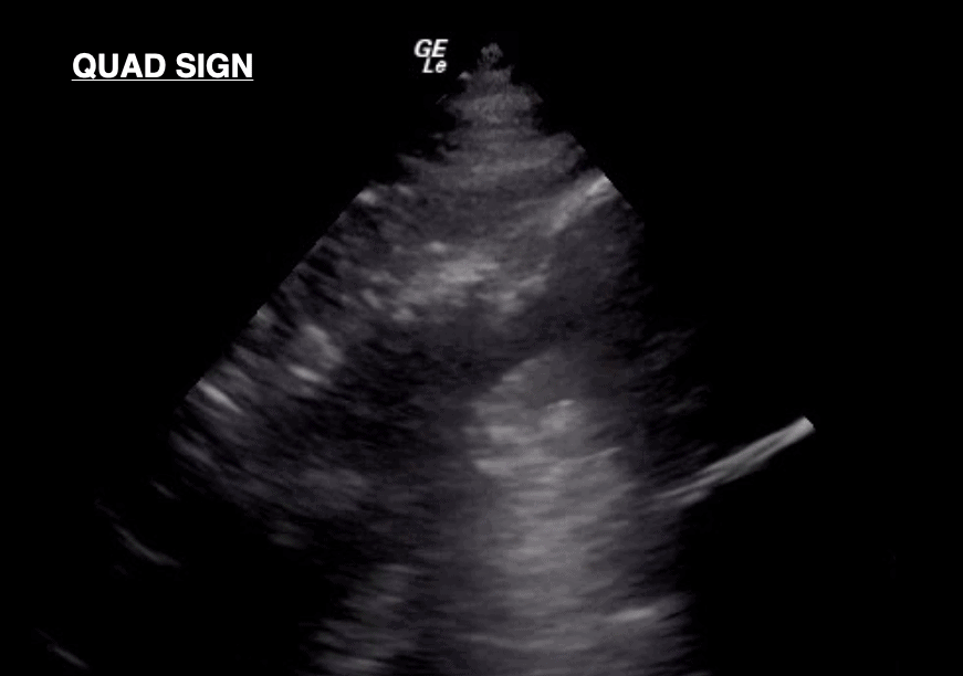 Quad Sign Lung Ultrasound Unlabeled