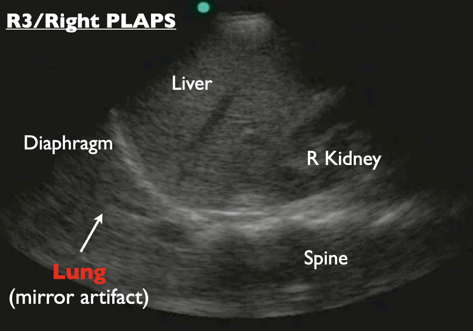 R3 Right PLAPS labeled - diaphragm lung, spine