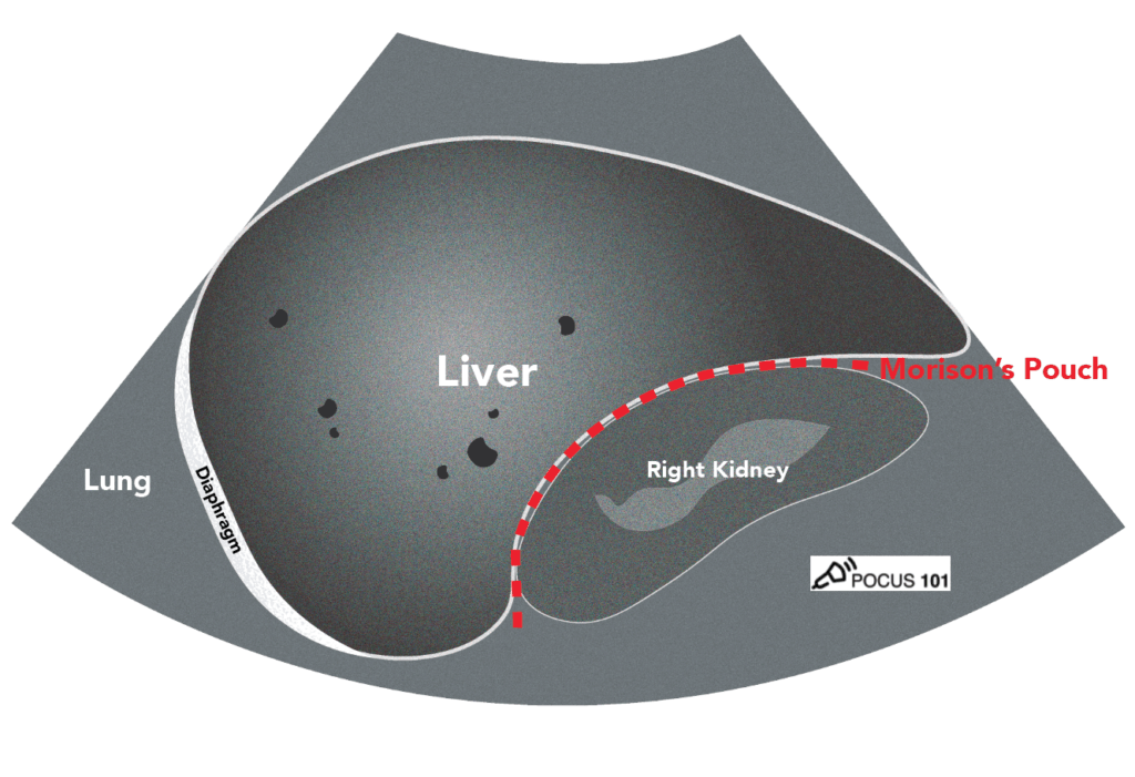 Right Upper Quadrant RUQ Morison's Pouch eFAST ultrasound Potential Space Illustration