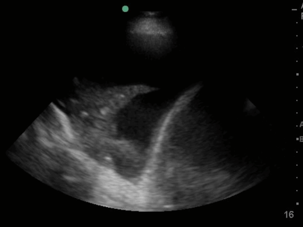 Simple Pleural Effusion on Ultrasound