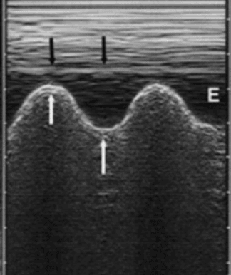 Sinusoid Sign on Lung Ultrasound