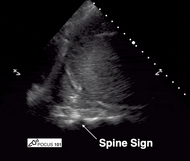 Spine Sign Ultrasound Pleural Effusion Consolidation