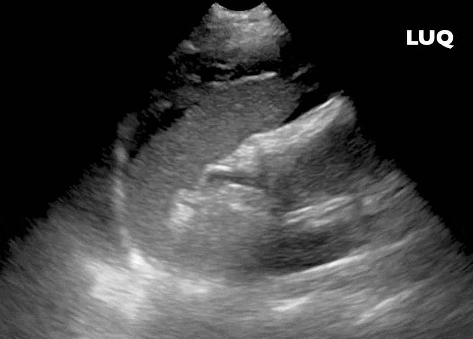 Splenorenal Left Upper Quadrant LUQ Perisplenic Free Fluid Ultrasound eFAST exam