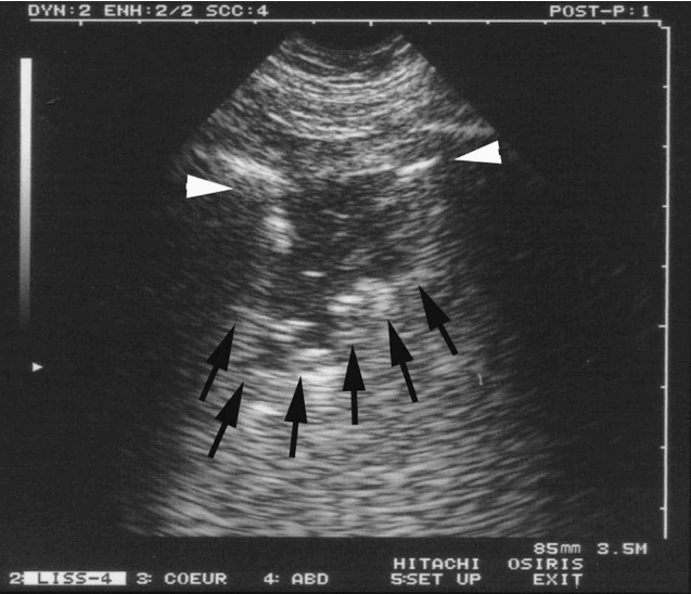 The shred sign lung ultrasound thoracic pneumonia