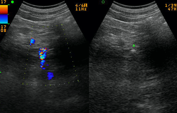 Abdominal Ultrasound Made Easy: Step-By-Step Guide - POCUS 101