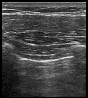 Ultrasound Lung Sliding with Linear Probe