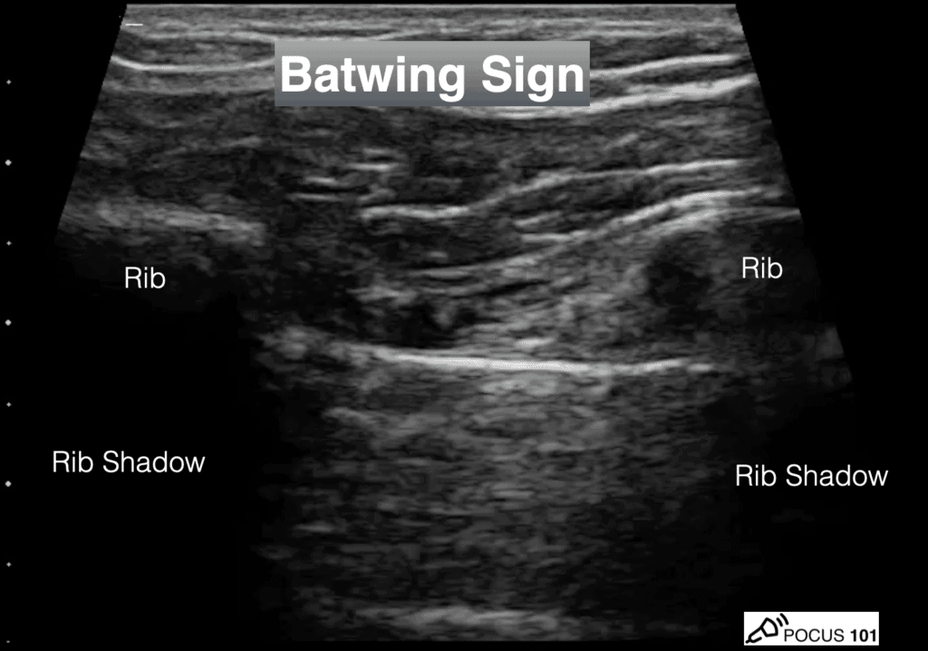 batwing sign - Lung Ultrasound Rib shadows