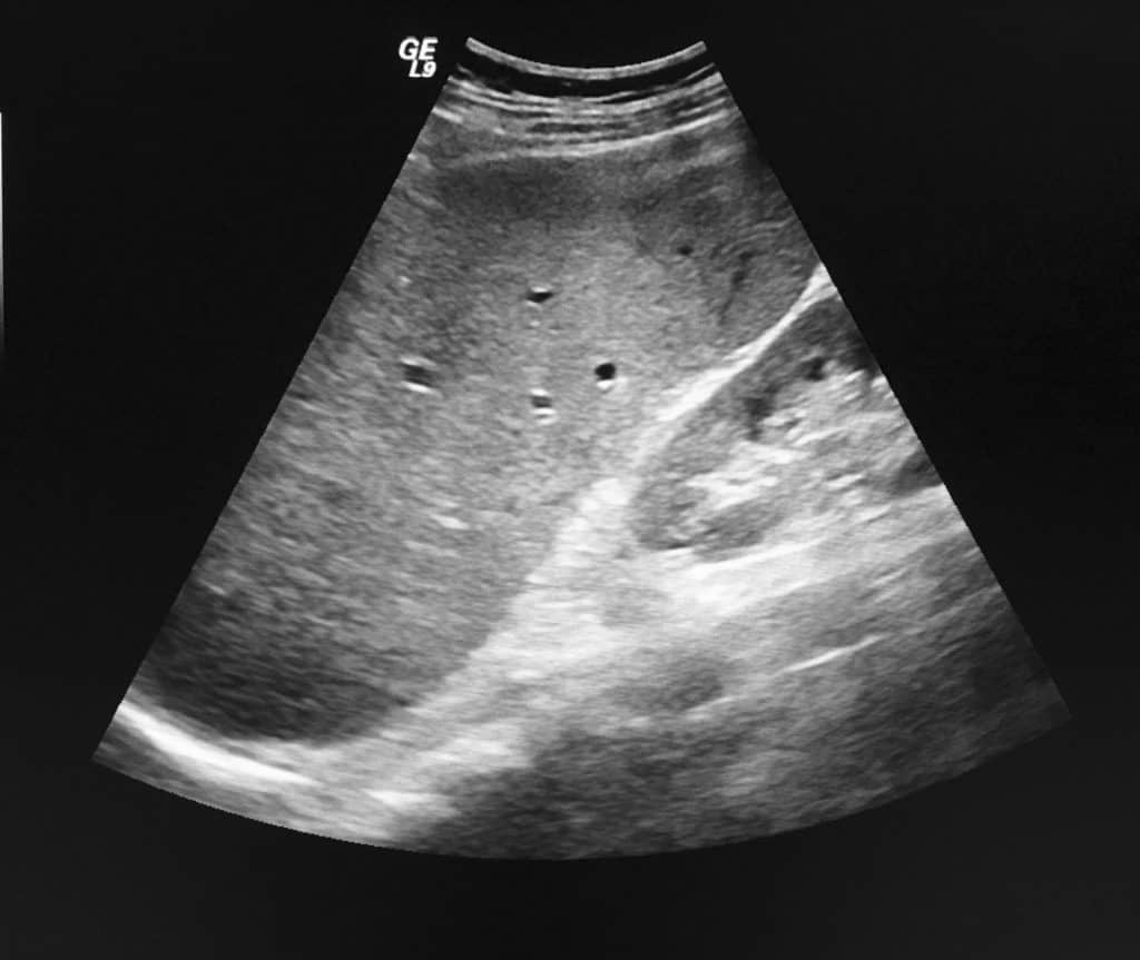 splenomegaly ultrasound enlarged spleen