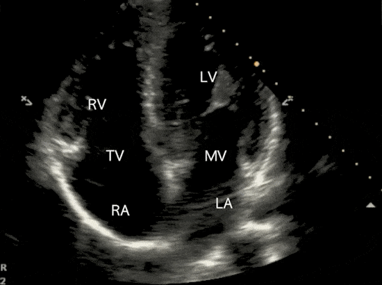 Cardiac Ultrasound Echocardiography Apical 4 Chamber view A4C Ultrasound Video